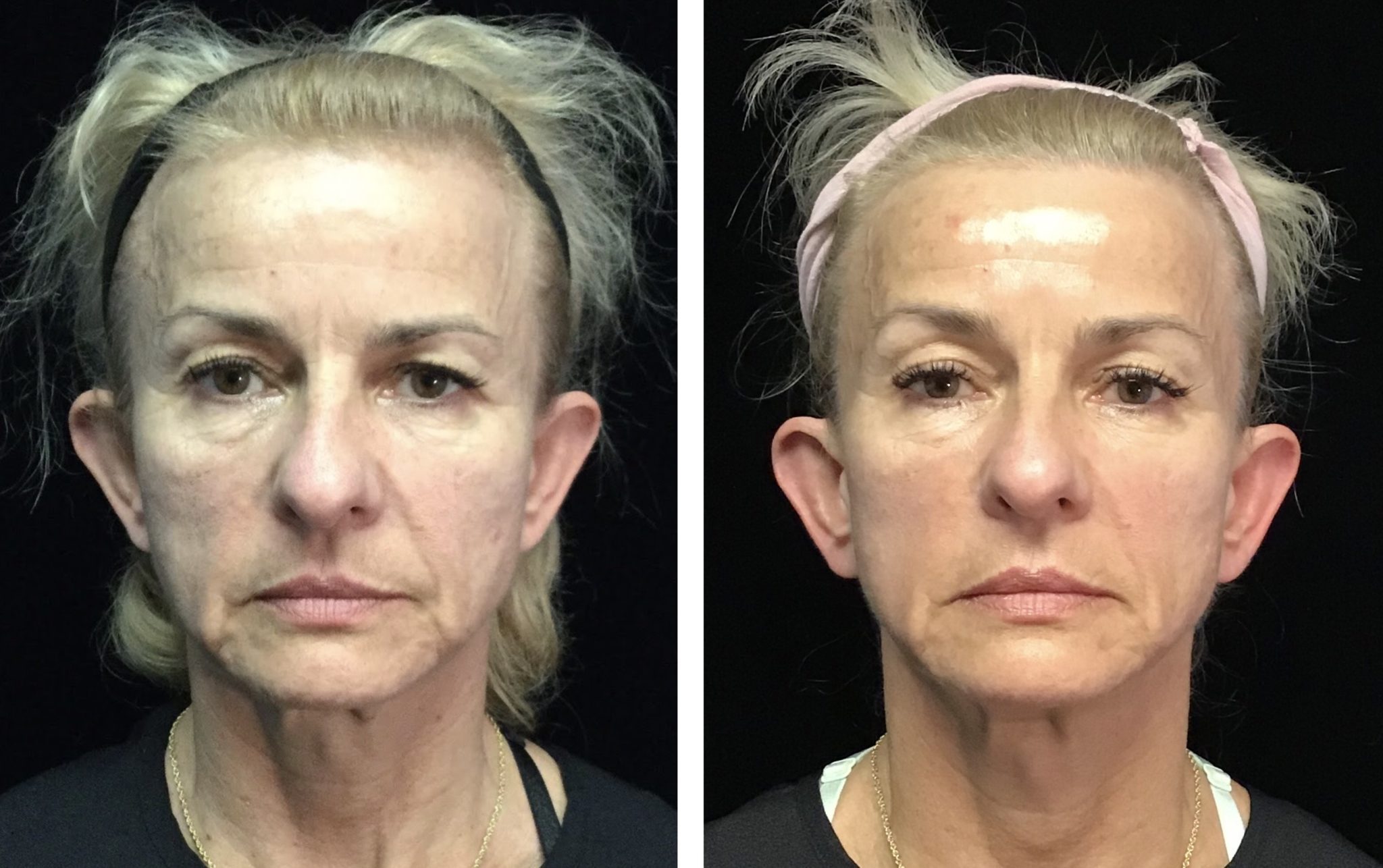 Ultherapy Treatment for Brow Lift & Skin Tightening | Mirabile MD