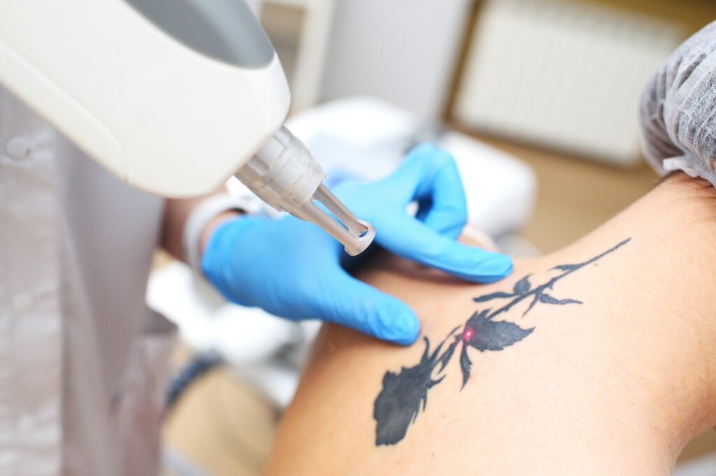 laser tattoo removal treatment